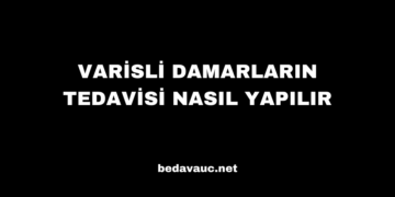 Varisli Damarların Tedavisi Nasıl Yapılır
